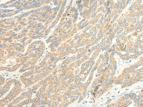 Immunohistochemistry of paraffin-embedded Human liver cancer tissue using TTC4 Polyclonal Antibody at dilution of 1:45(×200)