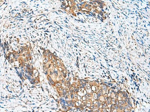Immunohistochemistry of paraffin-embedded Human cervical cancer tissue using CAMSAP3 Polyclonal Antibody at dilution of 1:110(×200)