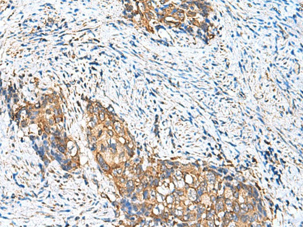 Immunohistochemistry of paraffin-embedded Human cervical cancer tissue using CAMSAP3 Polyclonal Antibody at dilution of 1:110(×200)