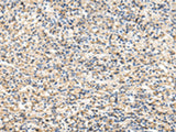 Immunohistochemistry of paraffin-embedded Human prost at e cancer tissue using VCAM1 Polyclonal Antibody at dilution of 1:30(×200)