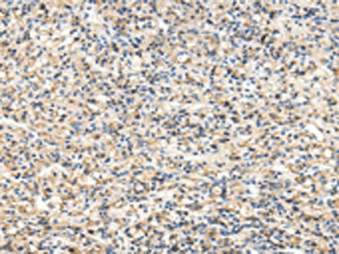 Immunohistochemistry of paraffin-embedded Human prost at e cancer tissue using VCAM1 Polyclonal Antibody at dilution of 1:30(×200)