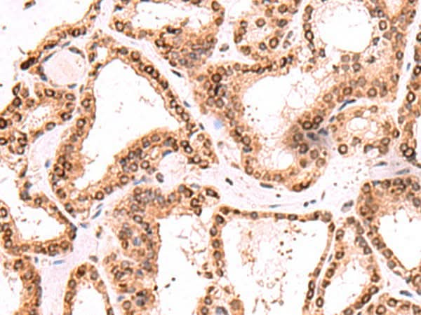 Immunohistochemistry of paraffin-embedded Human thyroid cancer tissue using TOR1AIP1 Polyclonal Antibody at dilution of 1:60(×200)