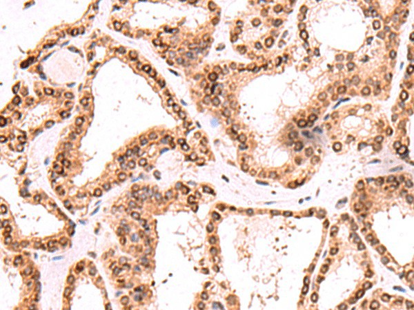 Immunohistochemistry of paraffin-embedded Human thyroid cancer tissue using TOR1AIP1 Polyclonal Antibody at dilution of 1:60(×200)