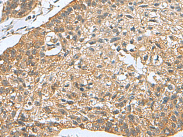 Immunohistochemistry of paraffin-embedded Human esophagus cancer tissue using PDCD5 Polyclonal Antibody at dilution of 1:105(×200)