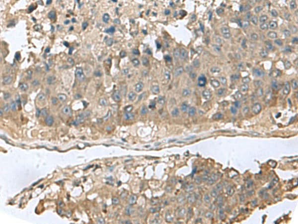 Immunohistochemistry of paraffin-embedded Human liver cancer tissue using GABARAPL2 Polyclonal Antibody at dilution of 1:60(×200)