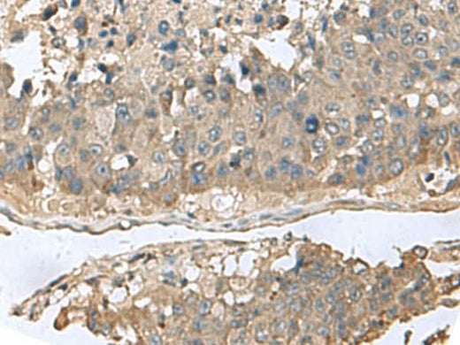 Immunohistochemistry of paraffin-embedded Human liver cancer tissue using GABARAPL2 Polyclonal Antibody at dilution of 1:60(×200)
