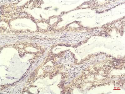 Immunohistochemistry of paraffin-embedded Human lung carcinoma tissue using IL8 Monoclonal Antibody at dilution of 1:200.