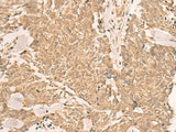 Immunohistochemistry of paraffin-embedded Human lung cancer tissue using IL1RAPL2 Polyclonal Antibody at dilution of 1:25(×200)