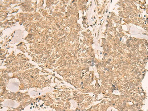 Immunohistochemistry of paraffin-embedded Human lung cancer tissue using IL1RAPL2 Polyclonal Antibody at dilution of 1:25(×200)
