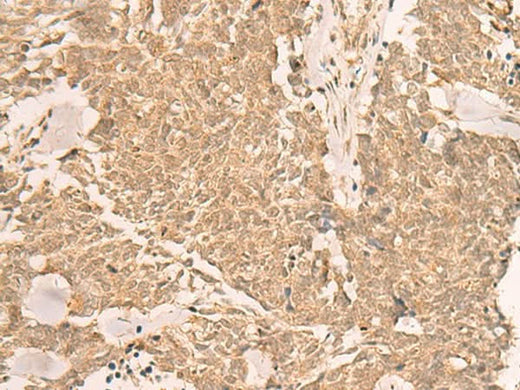 Immunohistochemistry of paraffin-embedded Human lung cancer tissue using IL1RAPL2 Polyclonal Antibody at dilution of 1:25(×200)