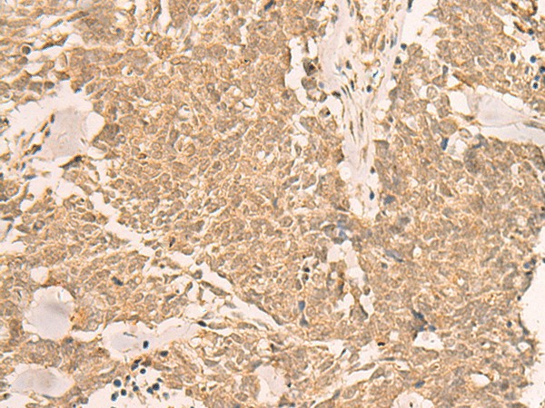 Immunohistochemistry of paraffin-embedded Human lung cancer tissue using IL1RAPL2 Polyclonal Antibody at dilution of 1:25(×200)