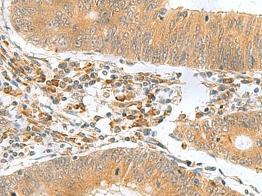 Immunohistochemistry of paraffin-embedded Human colorectal cancer tissue using MYDGF Polyclonal Antibody at dilution of 1:65(×200)