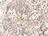 Immunohistochemistry of paraffin-embedded Human lung cancer tissue using NREP Polyclonal Antibody at dilution of 1:35(×200)