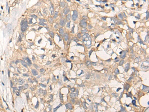 Immunohistochemistry of paraffin-embedded Human lung cancer tissue using NREP Polyclonal Antibody at dilution of 1:35(×200)