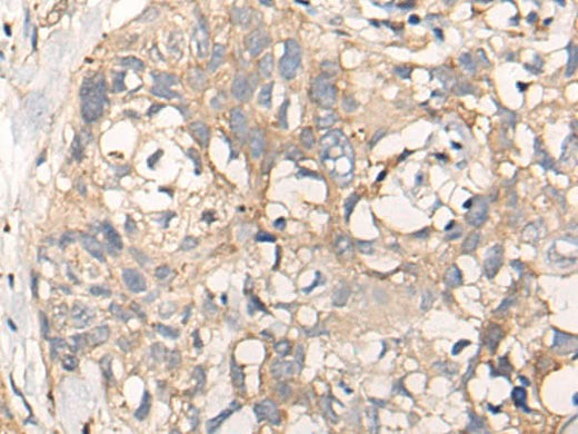 Immunohistochemistry of paraffin-embedded Human lung cancer tissue using NREP Polyclonal Antibody at dilution of 1:35(×200)