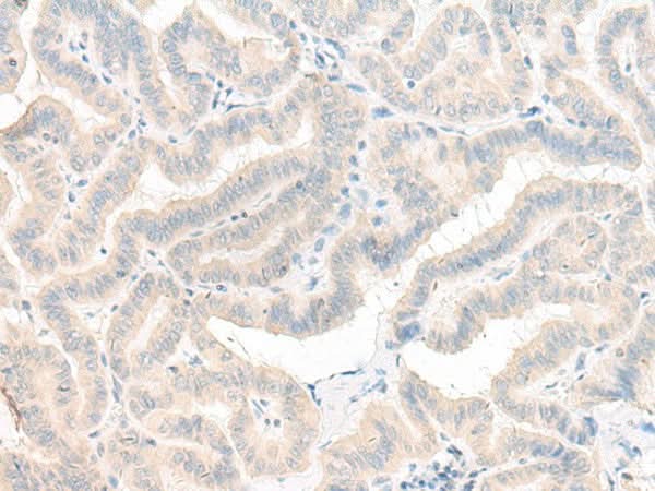 Immunohistochemistry of paraffin-embedded Human thyroid cancer tissue using AOAH Polyclonal Antibody at dilution of 1:25(×200)