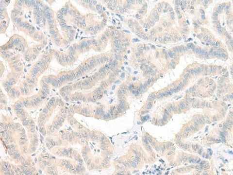 Immunohistochemistry of paraffin-embedded Human thyroid cancer tissue using AOAH Polyclonal Antibody at dilution of 1:25(×200)