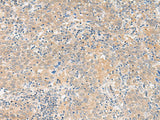 Immunohistochemistry of paraffin-embedded Human cervical cancer tissue using GALP Polyclonal Antibody at dilution of 1:45(×200)