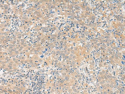 Immunohistochemistry of paraffin-embedded Human cervical cancer tissue using GALP Polyclonal Antibody at dilution of 1:45(×200)