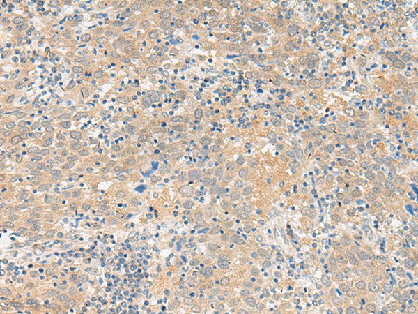 Immunohistochemistry of paraffin-embedded Human cervical cancer tissue using GALP Polyclonal Antibody at dilution of 1:45(×200)