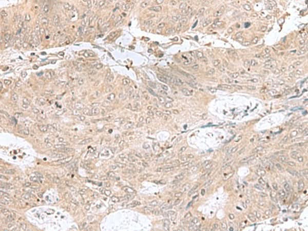Immunohistochemistry of paraffin-embedded Human colorectal cancer tissue using RPL35 Polyclonal Antibody at dilution of 1:50(×200)