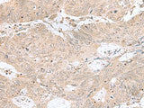 Immunohistochemistry of paraffin-embedded Human colorectal cancer tissue using RPL35 Polyclonal Antibody at dilution of 1:50(×200)