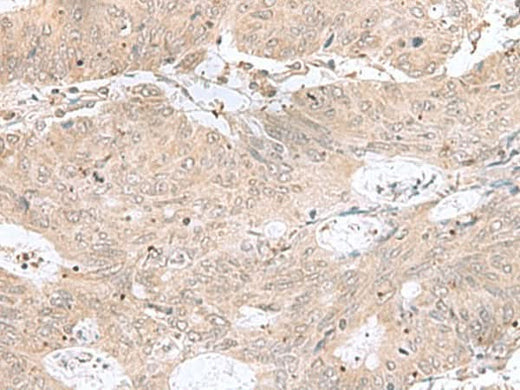 Immunohistochemistry of paraffin-embedded Human colorectal cancer tissue using RPL35 Polyclonal Antibody at dilution of 1:50(×200)