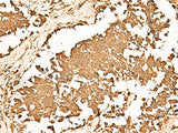 Immunohistochemistry of paraffin-embedded Human lung cancer tissue using PWP1 Polyclonal Antibody at dilution of 1:70(×200)
