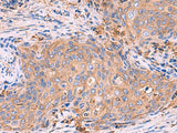 Immunohistochemistry of paraffin-embedded Human cervical cancer tissue using G6PC Polyclonal Antibody at dilution of 1:70(×200)