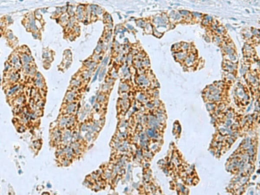 Immunohistochemistry of paraffin-embedded Human gastric cancer tissue using PYCR2 Polyclonal Antibody at dilution of 1:35(×200)