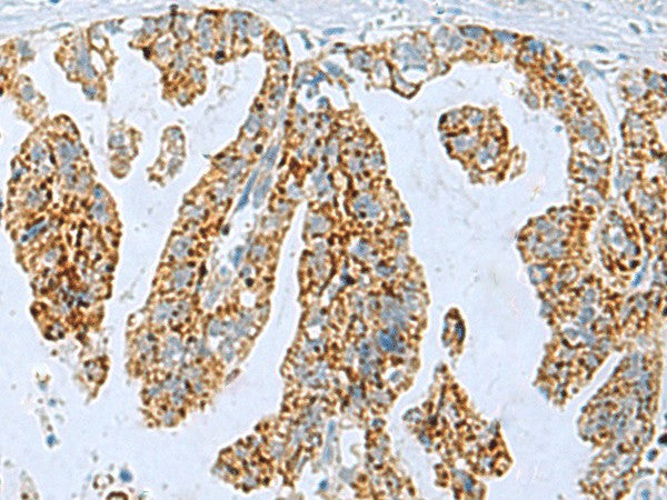 Immunohistochemistry of paraffin-embedded Human gastric cancer tissue using PYCR2 Polyclonal Antibody at dilution of 1:35(×200)