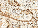 Immunohistochemistry of paraffin-embedded Human esophagus cancer tissue using METTL1 Polyclonal Antibody at dilution of 1:50(×200)