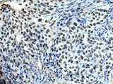 Immunohistochemistry of paraffin-embedded Human esophagus cancer tissue using DDX39A Polyclonal Antibody at dilution of 1:65(×200)