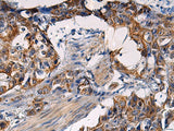 Immunohistochemistry of paraffin-embedded Human esophagus cancer tissue using RITA1 Polyclonal Antibody at dilution of 1:50(×200)