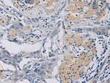 Immunohistochemistry of paraffin-embedded Human esophagus cancer tissue using KLF1 Polyclonal Antibody at dilution of 1:35(×200)
