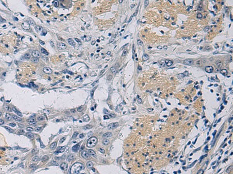 Immunohistochemistry of paraffin-embedded Human esophagus cancer tissue using KLF1 Polyclonal Antibody at dilution of 1:35(×200)