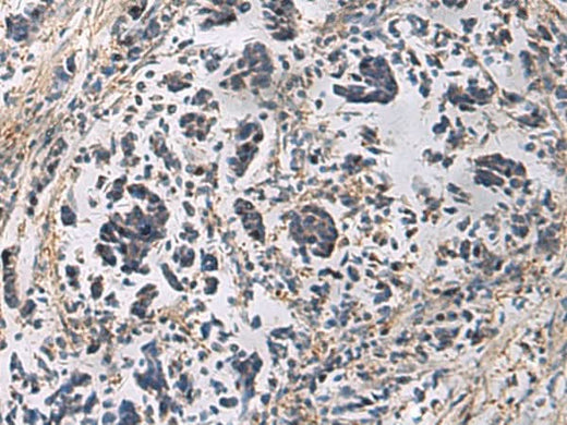 Immunohistochemistry of paraffin-embedded Human breast cancer tissue using GRIK2 Polyclonal Antibody at dilution of 1:60(×200)