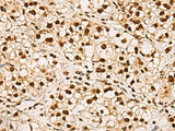 Immunohistochemistry of paraffin-embedded Human liver cancer tissue using ELF5 Polyclonal Antibody at dilution of 1:75(×200)