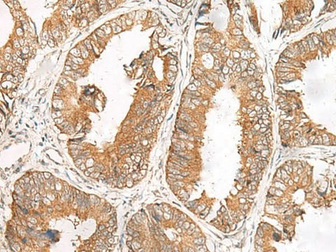 Immunohistochemistry of paraffin-embedded Human colorectal cancer tissue using FERD3L Polyclonal Antibody at dilution of 1:85(×200)