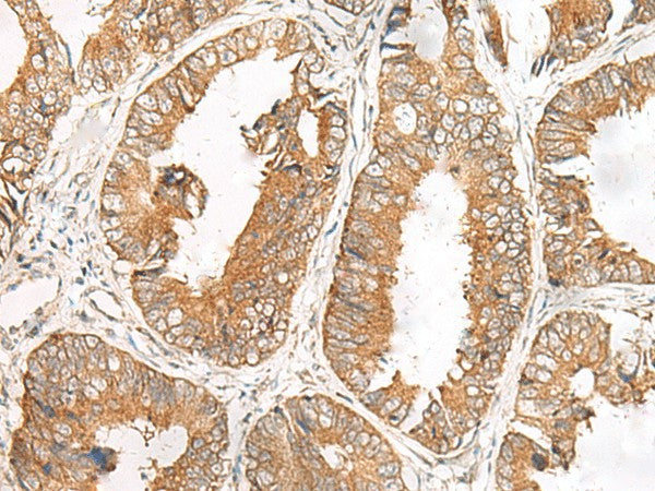 Immunohistochemistry of paraffin-embedded Human colorectal cancer tissue using FERD3L Polyclonal Antibody at dilution of 1:85(×200)