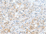 Immunohistochemistry of paraffin-embedded Human liver cancer tissue using DNAL1 Polyclonal Antibody at dilution of 1:70(×200)