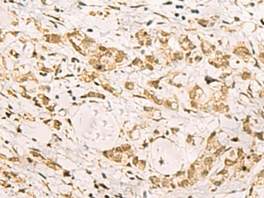 Immunohistochemistry of paraffin-embedded Human gastric cancer tissue using PDS5A Polyclonal Antibody at dilution of 1:90(×200)