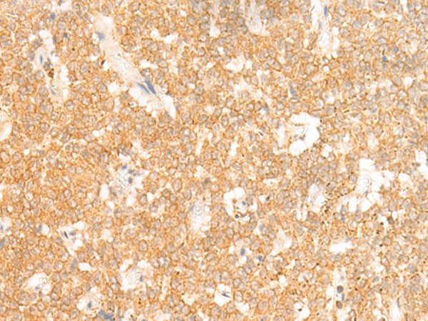 Immunohistochemistry of paraffin-embedded Human ovarian cancer tissue using RRP8 Polyclonal Antibody at dilution of 1:50(×200)