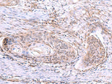 Immunohistochemistry of paraffin-embedded Human esophagus cancer tissue using AKAP17A Polyclonal Antibody at dilution of 1:80(×200)