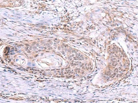 Immunohistochemistry of paraffin-embedded Human esophagus cancer tissue using AKAP17A Polyclonal Antibody at dilution of 1:80(×200)