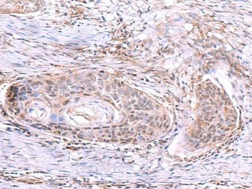 Immunohistochemistry of paraffin-embedded Human esophagus cancer tissue using AKAP17A Polyclonal Antibody at dilution of 1:80(×200)