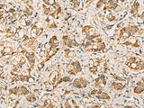 Immunohistochemistry of paraffin-embedded Human liver cancer tissue using VTA1 Polyclonal Antibody at dilution of 1:60(×200)