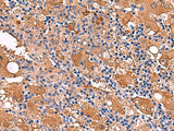 Immunohistochemistry of paraffin-embedded Human liver cancer tissue using FUCA2 Polyclonal Antibody at dilution of 1:80(×200)