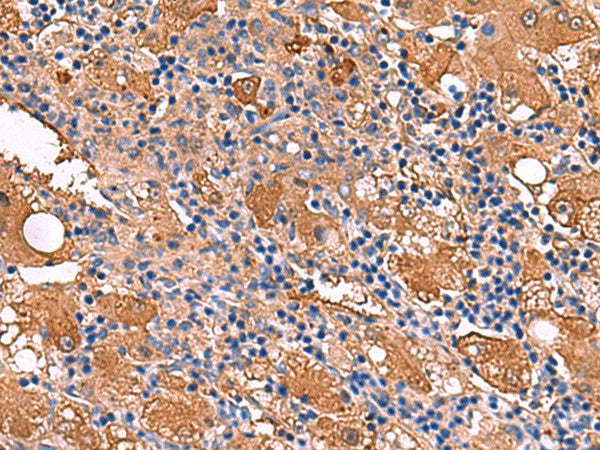 Immunohistochemistry of paraffin-embedded Human liver cancer tissue using FUCA2 Polyclonal Antibody at dilution of 1:80(×200)