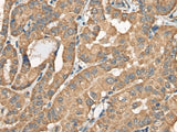 Immunohistochemistry of paraffin-embedded Human thyroid cancer tissue using BCHE Polyclonal Antibody at dilution of 1:40(×200)